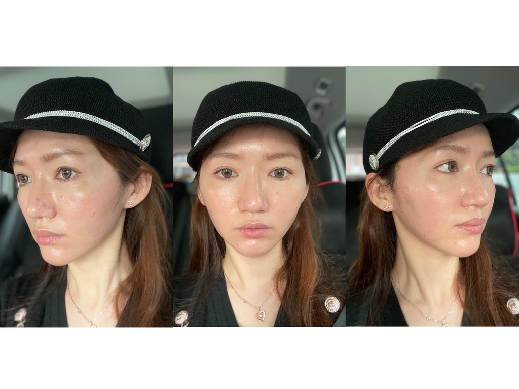 【醫美分享】大安區夏爾診所│第一次線雕拉提心得分享│美麗就要零死角│ @混血珊莎的奇幻旅程